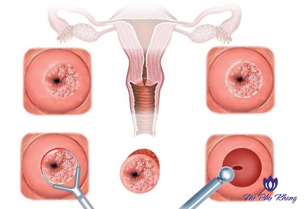 Điểm danh 4 bước khám viêm cổ tử cung chính xác nhất