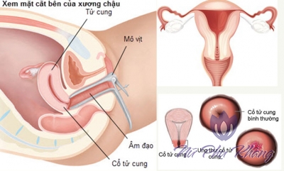 Viêm cổ tử cung và những điều phụ nữ ai cũng cần phải biết