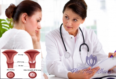 Tổng hợp những điều cần biết về viêm lộ tuyến cổ tử cung