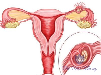 3 điều quan trọng về viêm ống dẫn trứng chị em nào cũng cần biết