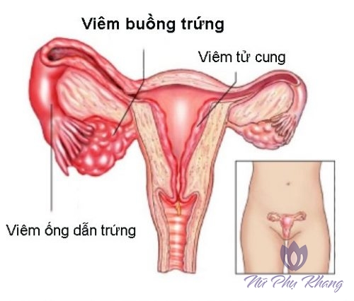 3 điều quan trọng về viêm ống dẫn trứng chị em nào cũng cần biết