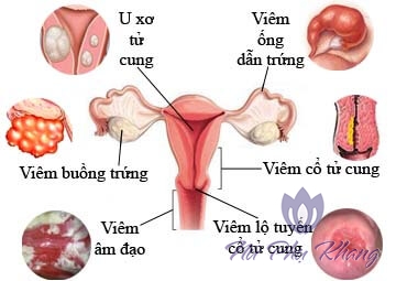 3 điều quan trọng về viêm ống dẫn trứng chị em nào cũng cần biết