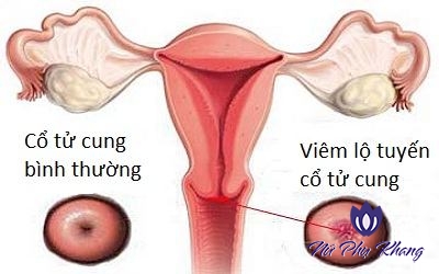 Viêm lộ tuyến cổ tử cung cấp độ 3 – nguy cơ phát triển thành ung thư cổ tử cung