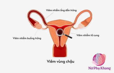 Viêm ống dẫn trứng gây biến chứng vô sinh ở nữ giới
